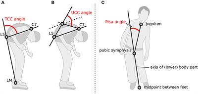 The Effect of Medication and Deep Brain Stimulation on Posture in Parkinson's Disease